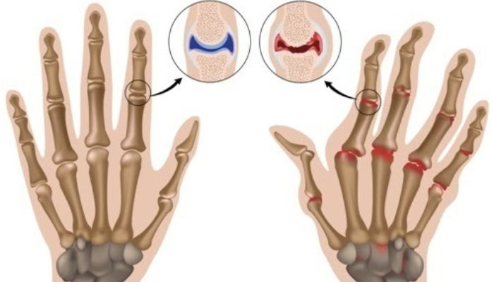 3D打印手指植入物可以彻底改变风湿病的治疗